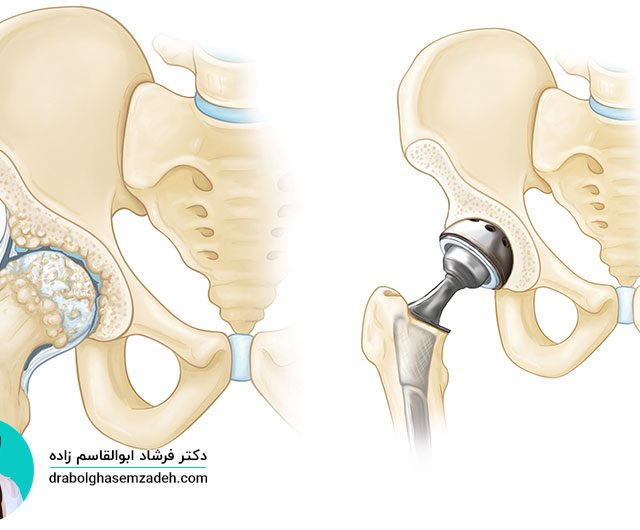 بهترین جراح تعویض مفصل لگن