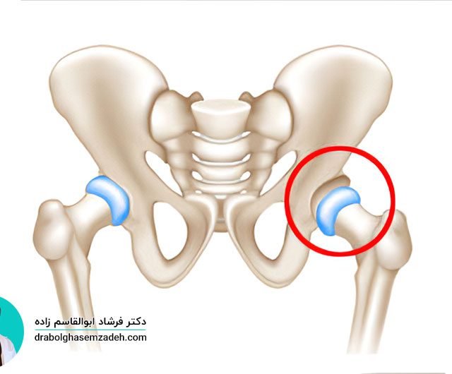 روش های درمان دررفتگی مادرزادی لگن