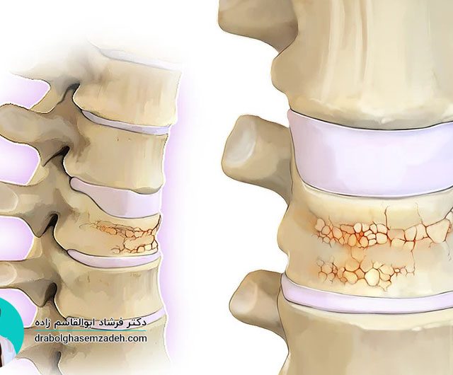علت پوکی استخوان چیست
