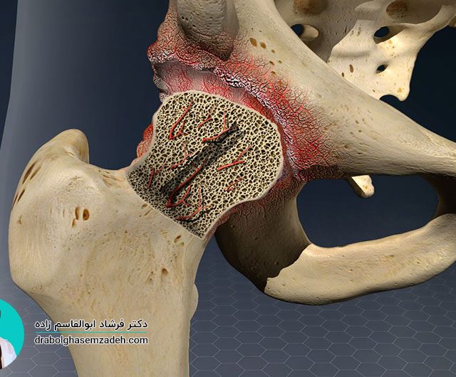 راه های درمان سیاه شدن سر استخوان ران
