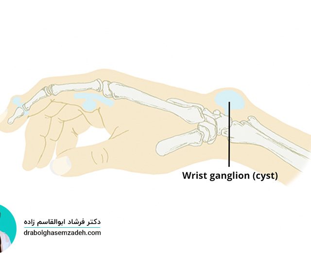 کیست گانگلیون چیست؟