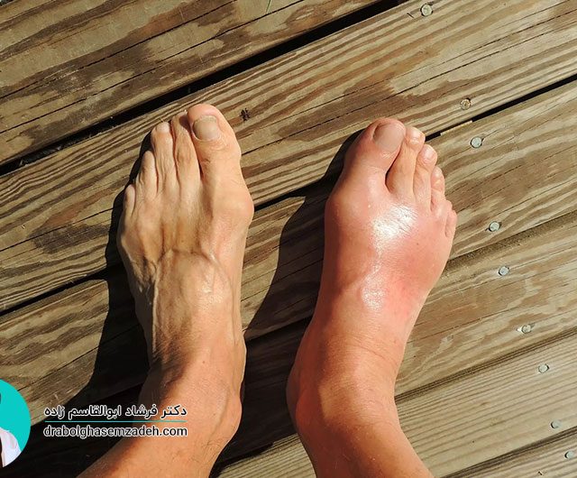 علائم و درمان بیماری نقرس