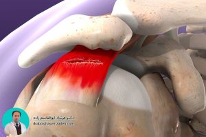 پارگی روتاتور کاف شانه چیست؟