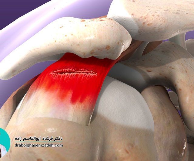پارگی روتاتور کاف شانه چیست؟