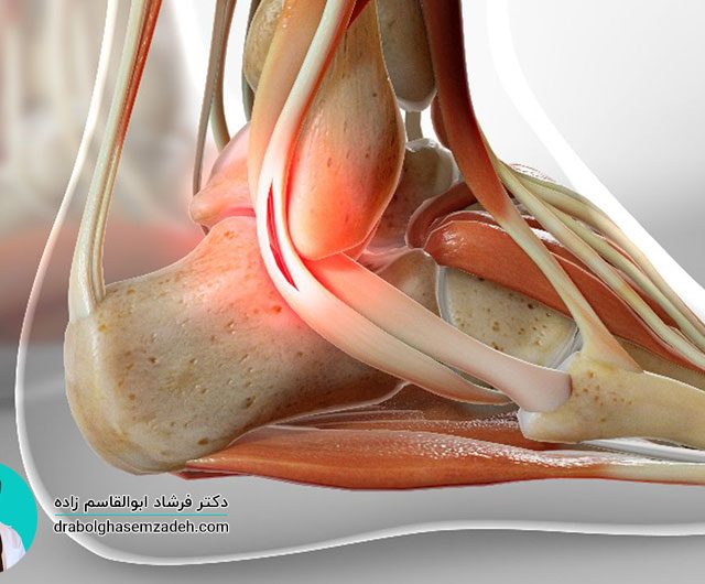 پارگی تاندون مچ پا