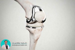 تعویض هم زمان مفصل دو زانو جراحی تعویض مفصل زانو