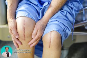 تعویض هم زمان مفصل دو زانو