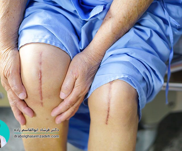 تعویض هم زمان مفصل دو زانو