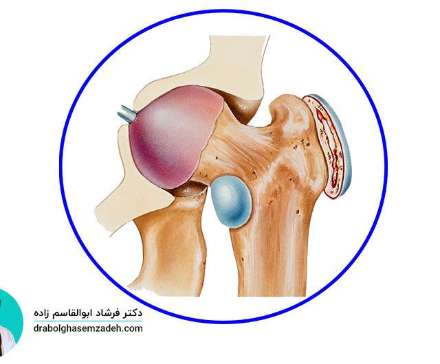 علائم و درمان بورسیت لگن