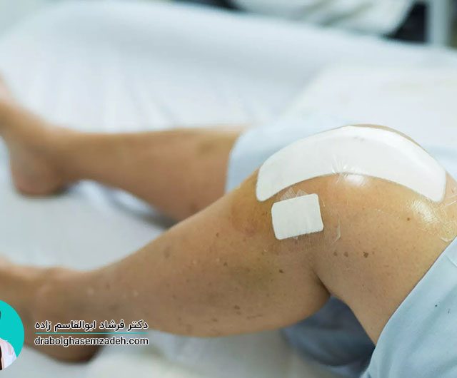 مراقبت های بعد از عمل آرتروسکوپی زانو