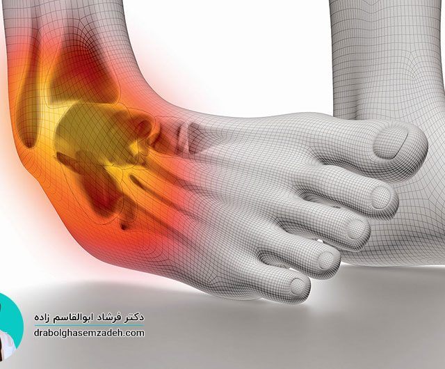 درمان پیچ خوردگی مچ پا