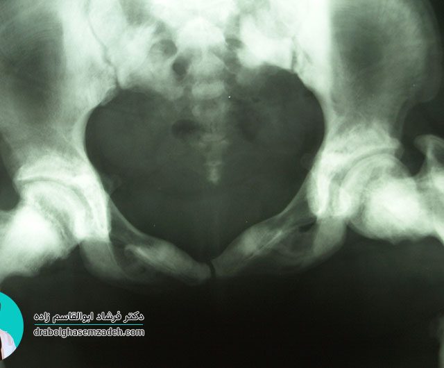 بیماری استخوان مرمری چیست؟