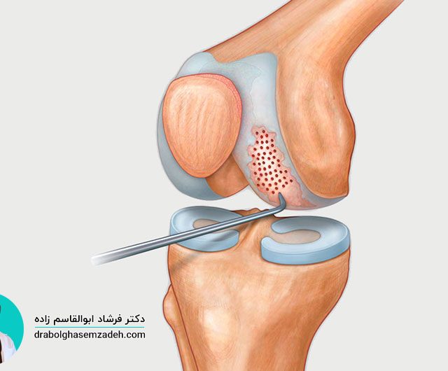جراحی میکروفرکچر زانو چیست؟