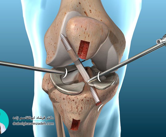 جراحی آرتروسکوپی رباط صلیبی زانو