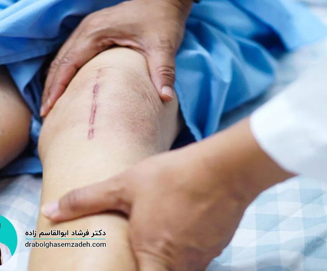 مراقبت های بعد از جراحی تعویض مفصل زانو