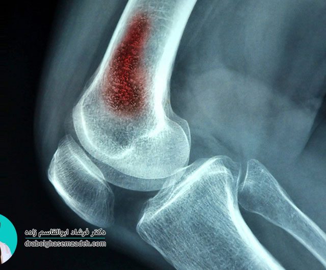 علائم و درمان عفونت استخوان