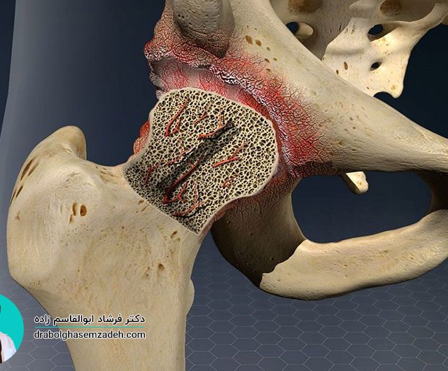 درمان نکروز استخوان بدون جراحی