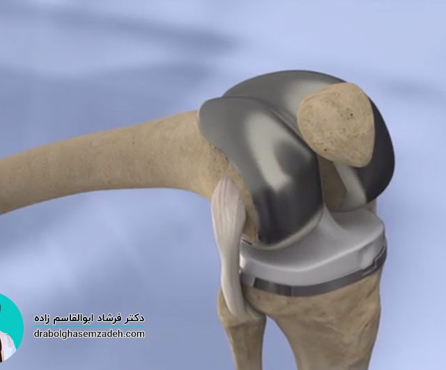 جراحی آرتروپلاستی چیست؟