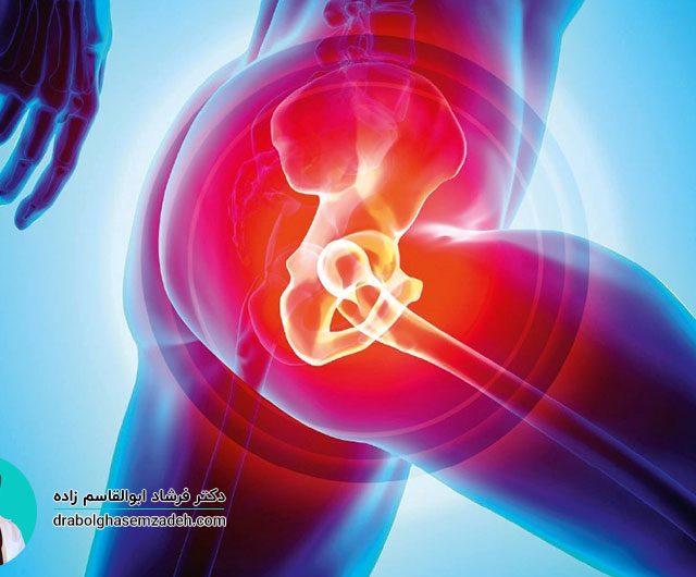 درمان آرتروز لگن