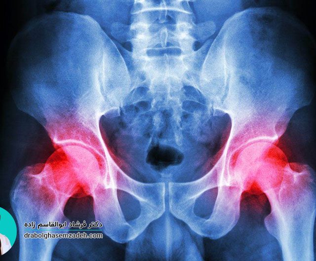 بیماری نکروز آواسکولار چیست؟