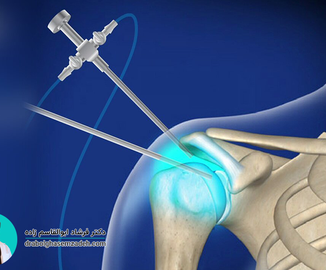 انواع جراحی شانه