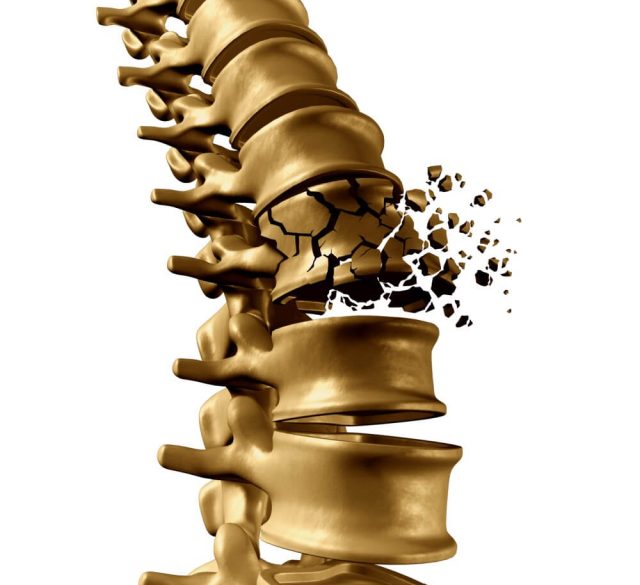 علائم شکستگی ستون فقرات