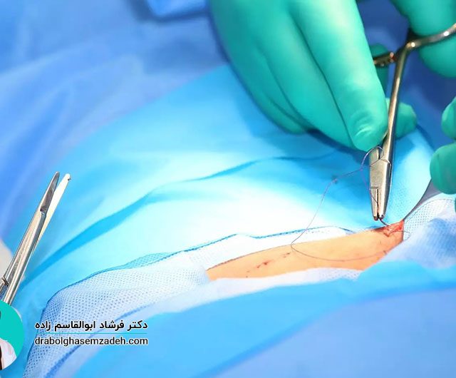 جراحی دیسک کمر