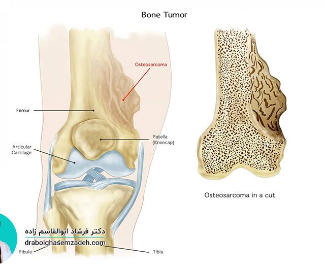 علت مراجعه به بهترین جراح تومور استخوان جراحی تومورهای استخوانی