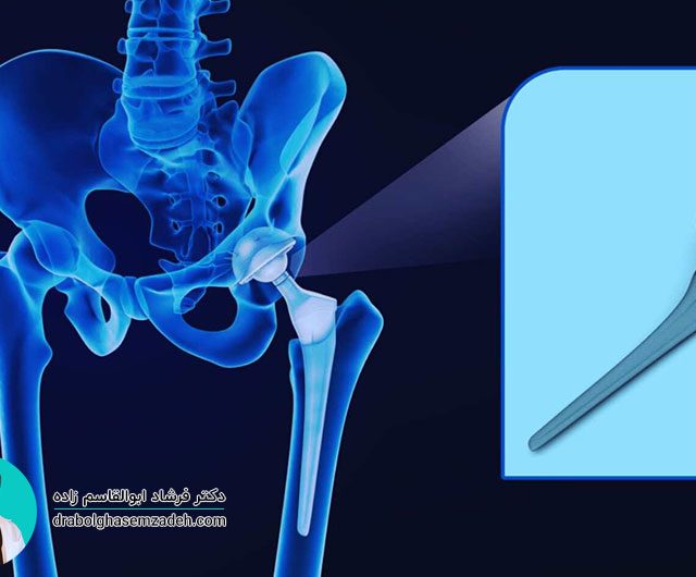علائم و روش های درمان بیماری نکروز سر استخوان ران