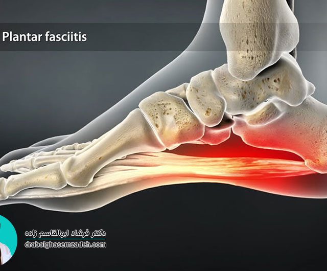 جراحی صافی کف پا چیست؟