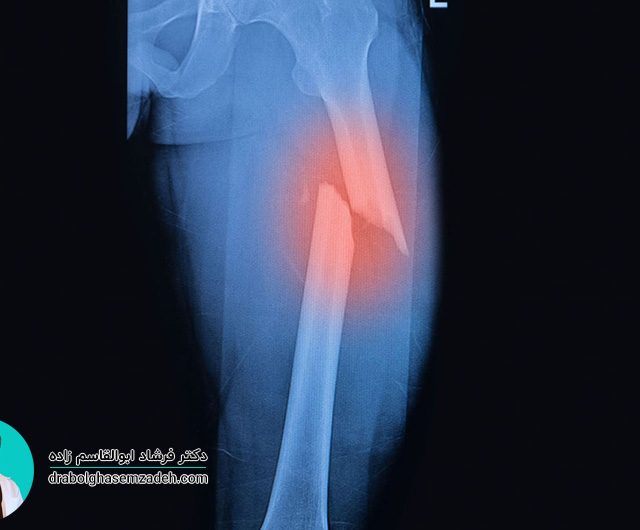 درمان شکستگی فمور