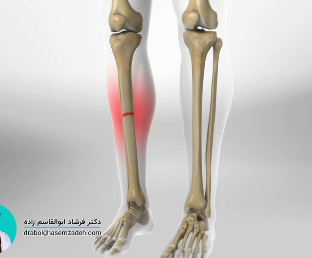 ترمیم شکستگی ساق پا