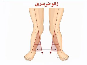 پای ضربدری