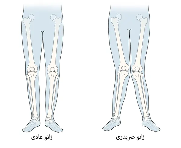 پای ضربدری چیست ؟